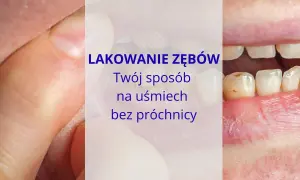 Jak skutecznie zapobiec próchnicy? Odkryj sekrety dentysty!