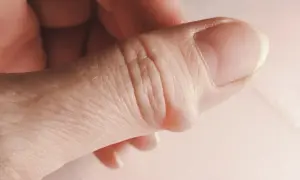 Nahaufnahme eines Daumens mit einem sichtbaren Ganglion am Finger.