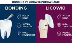 Porównanie metod poprawy uśmiechu: bonding (niższy koszt, mała inwazyjność) vs. licówki (wyższy koszt, większa inwazyjność). Jak wyprostować zęby bez aparatu?