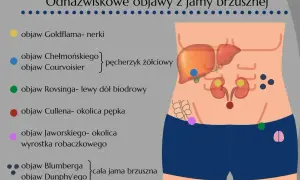 Schemat jamy brzusznej z zaznaczonymi objawami, w tym objaw Jaworskiego w okolicy wyrostka robaczkowego.