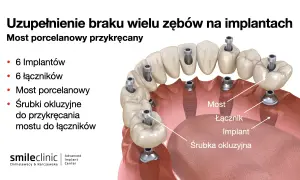 Ilustracja pokazuje, jak uzupełnić brak jednego zęba za pomocą mostu porcelanowego przykręcanego na 6 implantach. Widoczne są implanty, łączniki i śrubki.