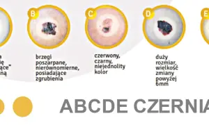 ABCDE czerniaka: asymetria, brzegi, kolor, duży rozmiar, ewolucja.