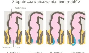 Ilustracja przedstawia cztery etapy rozwoju hemoroidów zewnętrznych, od I do IV stopnia, pokazując ich stopniowe powiększanie się.