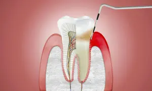Przekrój zęba z widocznymi naczyniami krwionośnymi i nerwami. Narzędzie dentystyczne dotyka zęba, sugerując rozpierający ból dziąseł.