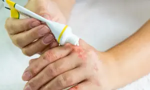 Osoba aplikuje dermovate maść na suchą, zaczerwienioną skórę dłoni.