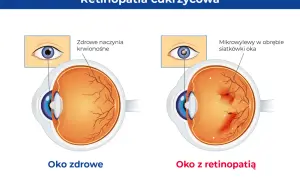Porównanie zdrowego oka z naczyniami krwionośnymi siatkówki i oka z retinopatią cukrzycową, gdzie widoczne są mikrowylewy.