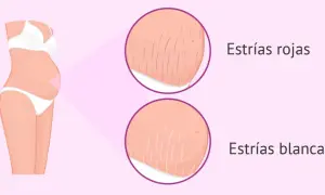 Ilustración de abdomen de embarazada con primeros planos de estrías rojas y blancas, mostrando las marcas comunes del embarazo.