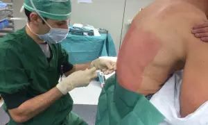Un médecin administre une anesthésie péridurale à un patient. La zone du dos du patient est désinfectée et préparée pour l'injection.