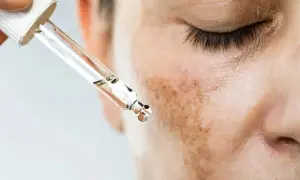 Gotas de suero aplicándose sobre manchas melasma en la mejilla de una persona.