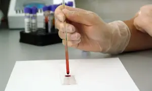 Ręka w rękawiczce pobiera próbkę krwi do badania. Cena hemoglobiny glikowanej jest kluczowa dla monitorowania cukrzycy.