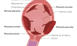 Schematische Darstellung des Uterus mit verschiedenen Plazentapositionen. Was ist die Plazenta? Sie ist ein Organ, das sich während der Schwangerschaft entwickelt.