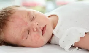 Czy witamina D3 może uczulać? Rzadkie reakcje alergiczne u dzieci