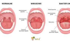 Porównanie gardła: normalne, wirusowe (zaczerwienienie, obrzęk języczka) i bakteryjne (białe plamy, szary język).