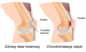 Porównanie zdrowego stawu kolanowego z zaawansowaną chondropatią 3 stopnia kolana, gdzie chrząstka jest mocno uszkodzona.