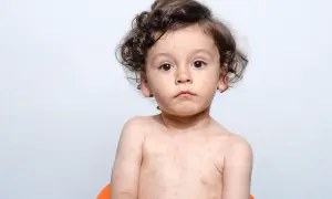 Małe dziecko z kręconymi włosami ma na skórze wysypkę, która przypomina plamki po śwince.