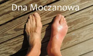 Dna moczanowa: Jak rozpoznać, leczyć i żyć bez bólu?