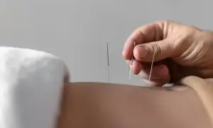Akupunktura na nerwicę: Czy działa? Jak wspomaga leczenie?