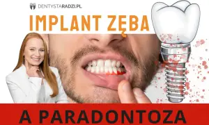 Implant zęba a paradontoza. Krwawiące dziąsła i implant zębowy z plamami krwi. Dentystka radzi.