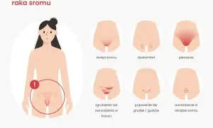 Ilustracja pokazuje wczesne objawy raka sromu: świąd, dyskomfort, pieczenie, zgrubienia, grudki i owrzodzenia.