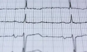 EKG pokazuje rytm serca. Czy nerwica serca wyjdzie na EKG? Zapis pokazuje fale, które mogą być interpretowane przez lekarza.
