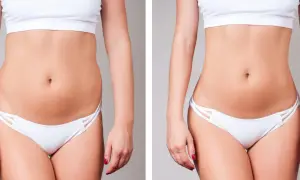 Avant/après d'une liposuccion ventre. Une silhouette affinée et une taille plus marquée après l'intervention.