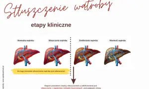 Grafika pokazuje etapy stłuszczenia wątroby: od normalnej, przez stłuszczenie (które jest odwracalne!), zwłóknienie, aż do marskości.