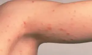 Brazo con erupción de pequeños puntos rojos, posiblemente hongos, manchas rosadas en la piel.