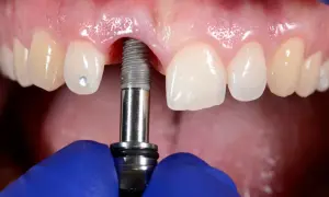 Zabieg wszczepienia implantu dentystycznego w szczękę. Widoczne są zęby, dziąsła i narzędzie stomatologiczne.