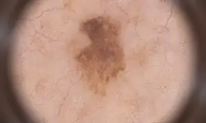 Dermatoskopische Aufnahme eines unregelmäßigen, braunen Muttermals mit feinen Gefäßen. Ein frühes Melanom zeigt sich oft so.