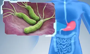 Bakterie Helicobacter pylori na błonie śluzowej żołądka. Czy helicobacter jest zaraźliwy? Tak, przenosi się drogą pokarmową.