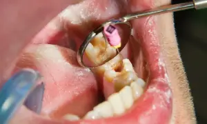 Dentysta wykonuje leczenie kanałowe jedynki. Widać narzędzie stomatologiczne w zębie i odbicie w lusterku.