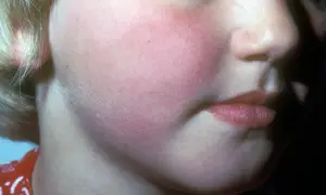Barnets kinder är röda och svullna, ett klassiskt tecken på femte sjukan.