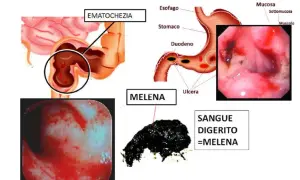 Illustrazione medica che mostra ematochezia e melena, sintomi di sanguinamento gastrointestinale, inclusa la presenza di sangue nelle feci.