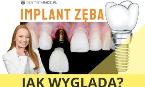 Zobacz, jak wygląda implant zęba: złoty element wkręcony w dziąsło i jego schematyczny rysunek z koroną.
