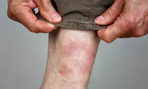 Rote, gereizte Haut am Bein, die auf einen Zeckenbiss hindeutet. Hände ziehen die Hose hoch.