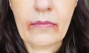 Pękające kąciki ust, zaczerwienienie i suchość skóry wokół ust.