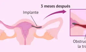 Ilustración muestra un implante en la trompa de Falopio, que causa obstrucción. Esto es un método de ligadura de trompas.