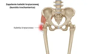 Leczenie zapalenia kaletki krętarzowej: Skuteczne leki i terapie