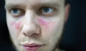 Czerwone plamy na policzkach mężczyzny, przypominające objawy tocznia rumieniowatego, z delikatnym połyskiem.