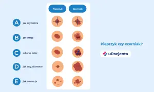 Ilustracja porównująca pieprzyk i czerniaka według kryteriów ABCDE.
