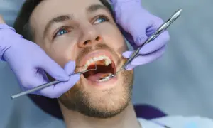 Dentysta usuwa kamień na zębach pacjenta za pomocą narzędzi stomatologicznych.