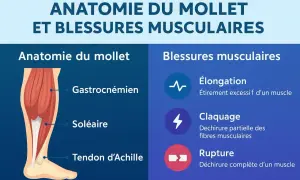 Anatomie du mollet et blessures musculaires, incluant le claquage, une déchirure musculaire du mollet.