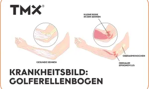 Vergleich gesunder und entzündeter Sehnen am Ellenbogen, der Golferellenbogen-Symptome zeigt. Kleine Risse in den Sehnen sind sichtbar.