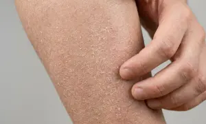 Eine Hand kratzt an stark trockener Haut, die schuppig und rissig aussieht. Dies deutet auf einen Mangel an Feuchtigkeit hin.