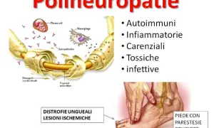Illustrazione delle polineuropatie: cause autoimmuni, infiammatorie, carenziali, tossiche, infettive. Danno alla guaina mielinica e al nervo. Piede con parestesie.