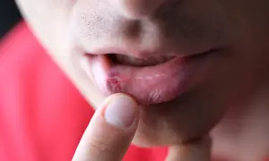 Zbliżenie na usta z widoczną raną, która może być objawem nawracającej opryszczki wargowej. Palec wskazujący dotyka ust.