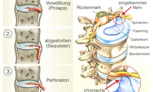 Illustration zeigt die Stadien einer Bandscheibenprotrusion LWS: Vorwölbung, abgestorbener Teil (Sequester) und Perforation, die zu einem eingeklemmten Nerv führen.