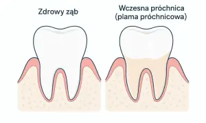 Zdrowy ząb obok zęba z wczesną próchnicą, która objawia się jako nieestetyczna, żółtawa plama.