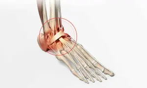 Illustration anatomique du pied montrant les conséquences d'une fracture mal soignée, avec une zone rouge entourant les tendons et ligaments de la cheville.