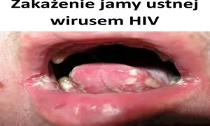 Zakażenie jamy ustnej wirusem HIV objawia się m.in. nalotem na języku i pleśniawkami.
